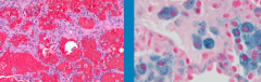 Siderophages - hemosideran laden macrophages in Alveolar (Capillary) Hemorrhage Syndrome

(samples taken via bronchoalveolar lavage (BAL), open biopsy)