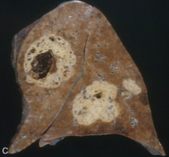 Wegener's Vasculitis:
- Perivascular, necrotizing granulomatous inflammation
- Lung necrosis and cavitation
- Hemorrhage