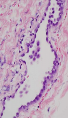 Normal Pleura - flat/squamous to cuboidal epithelium "mesothelium" that covers the pleural surface