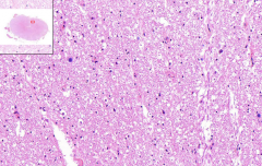 Brain
- Whitish spots - is the loss of myelin sheaths
- Myelin is pinkish - since they are proteins

Etiology?
What can you stain myelin with?
Where is the highest loss of myelin?
What is the typical course?
What is the cause of death?