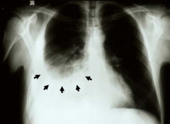 Pleural Effusion
- Fluid accumulates at bottom of lung
- Looks opacified d/t fluid collection in pleural space
- Blunting of costophrenic angle (where the diaphragm meets the ribs)