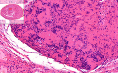 Some oval, demarcated round lesion with capsule
- Hypo- and hypercellular areas (what are they called?)
- Hypercellular areas arranged in palicading / radial structure
- Spindle cells with light eosinophilic cytoplasm
- No neurons

What is i...