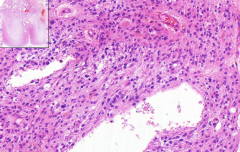 Brain
- Pleomorphism, mitotic activity, nucleoli
- See some necrotic areas
- Loads of vessels!
- high cellularity
- Maybe hemosiderin deposits - after bleeding

What is it?
Complications & prognosis?
What is normally mitotic index of brai...