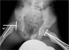 Hx:11yo obese M c/o SCFE. Which of the following figures accurately represents the method used to determine the xray severity of the epiphyseal slip and help guide tx? 1- Southwick method; 2- Klein's line; 3-Angle between the Hilgenreiner line and...