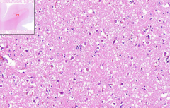 Brain
- Lots of vesicles and spaces = Spongiform architecture
- Loss of brain matter
- Loss of neurons - but no inflammatory reaction

Etiology?
Grossly?
Clinically?
Other diseases caused by same problem?