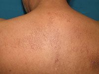 Which subset of cutaneous amyloidosis?
