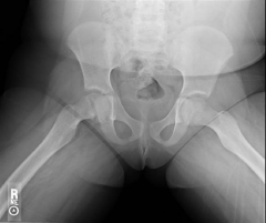 Hx:13yo Polynesian B c/o L groin pain and inability to place wt on the L leg xrays, Fig A & B. All of the following are true regarding this condition EXCEPT: 1-The L hip is MC involved; 2-Forceful manipulation is not indicated because it is assoc ...