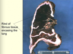 Along mesothelial surfaces; it does not project into the lung