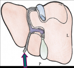 Contains the obliterated umbilical vein and connects w/ the left portal vein. 

The ligamentum teres is continuous w/ the parietal peritoneum and the coronary ligament