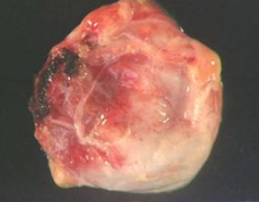 - Usually unilocular
- Lined by simple cuboidal epithelium
- May be filled w/ serous fluid
- Found on anterior-superior mediastinum (that have spread from thymus)