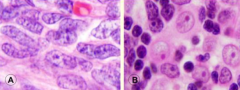 - Thymic epithelial cells (neoplastic proliferation)
- Abundant immature T-cells (non-neoplastic)

- Composed of: spindle cells (A) or round epithelioid cells (B) or both