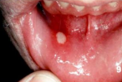 What is the term for non-infectious ulcers of the oral mucosa?