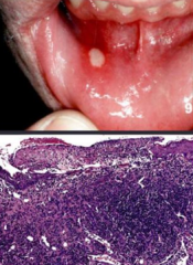 What is the cause of Canker Sores / Aphthous ulcers?