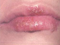 Herpes Stomatitis (HSV type 1)
- Person-to-person transmission