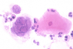 Tzanck test - swab ulcer and smear on slide

Look for 3 M's: 
- Multinucleated cells
- Molding (stick together)
- Margination (chromatin pushed to side, dark purple)