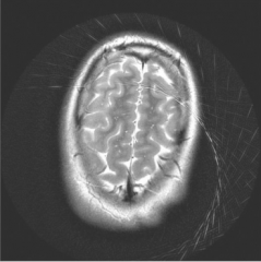 Zipper artifact in a noncartesian readout (like filtered backprojection)