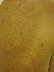 Mastocytosis of the skin is almost always indicative of systemic disease in adults.  What systemic symtpoms associated?
