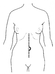 Incision down the middle of abdomen along and through the linea alba