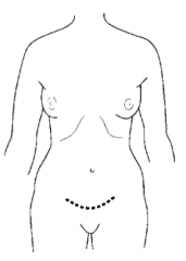 Low transverse abdominal incision with retraction of the rectus muscles laterally; most often used for gynecologic procedures