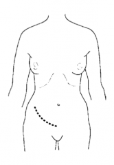 Lower quadrant; kidney placed extraperitoneally