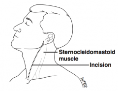 Carotid Endarterectomy


- Incision down anterior border of the sternocleidomastoid muscle to expose the carotid