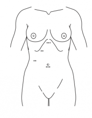 Four trocar incisions (one at level of xyphoid, one a couple of inches lower along rib, another a couple of inches lower along rib, and another midline by belly button)