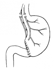 Antrectomy (remove antrum of stomach) with gastroduodenostomy (connect remaining stomach to duodenum)