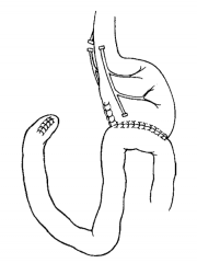 Antrectomy (remove antrum of stomach) with gastrojejunostomy (connect remaining stomach to jejunum)