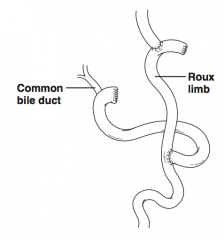 Jejunojejunostomy forming a Y-shaped figure of small bowel


 


The free end can then be anastomosed to a second hollow structure (eg, esophagojejunostomy)