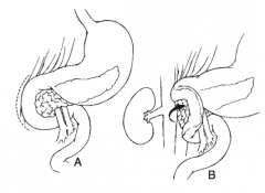 Dissection of the duodenum from the right-sided peritoneal attachment to allow mobilization and visualization of the back of the duodenum / pancreas