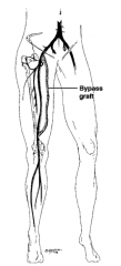 FEMoral artery to POPliteal artery bypass using synthetic graft or saphenous vein; used to bypass blockage in femoral artery