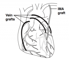 Coronary Artery Bypass Graft via saphenous vein graft or internal mamillary artery bypass grafts to coronary arteries from aorta (cardiac revascularization)