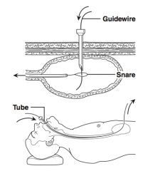 Percutaneous Endoscopic Gastrostomy


- Endoscope is placed in the stomach, which is then inflated with air


- A needle is passed into the stomach percutaneously


- Wire is passed through the needle traversing the abdominal wall


- Gast...