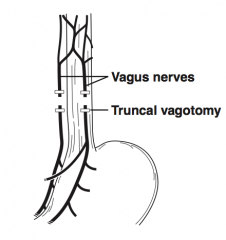 Transection of the vagus nerve trunks; must provide drainage procedure to stomach (eg, gastrojejunostomy or pyloroplasty) because after truncal vagotomy, the pylorus does not relax