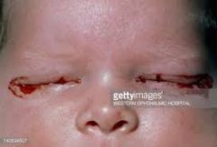 conjuctivitis- ocular congestion, edema and discharge develop a few days to several wees after birth and last for 1-2 weeks
pneumonia- usually afebrile illness presenting at 3-19 weeks after birth. Repetitive staccato cough and tachypnea are com...