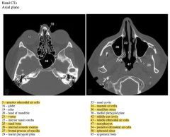 The image on the left is through the orbits and mastoid processes and is superior to the image on the right that is through the maxillary sinuses and atlas.


 


Ethmoid air cells are also apparent in the image on the left.


 


The ma...