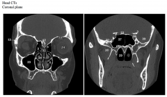The images above are from two different coronal planes. Which is more anterior? What clues did you use to determine this?


 


#17 and 24 and nasal conchae. Which two are they?


 


Why isn’t the third one seen?


 


Which air ...