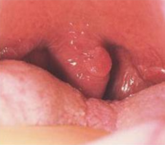- Lingual (tongue)
- Labial (lips)
- Buccal (cheek)
- Larynx