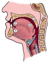 - Most: tongue (2) and floor of mouth (1)
- Also: gingiva, hard/soft palates (3), dorsal tongue (4), mucosa