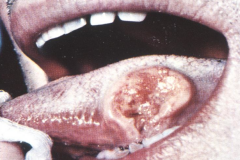Squamous Cell Carcinoma on the tongue