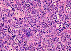 - Undifferentiated
- Lymphoepithelial carcinoma (numerous lymphocytes between tumor cells obscuring the epithelial (cohesive) derivation)