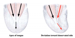 Bilateral contraction of the genioglossus muscles results in sticking out the tongue.


 


The line of pull of the individual genioglossus muscles is not in the midline; however, the summation of the two muscles results in the ability to sti...