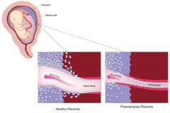 Abnormal invasion of trophoblasts into the
maternal tissue → 

 spiral arteries do not
undergo full physiological change → reduced placental blood flow