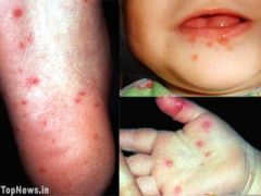 Entérovirus (coxsackie A16 ou EV71 +)
ulcères buccaux très douloureux associés à lésions paumes et plantes