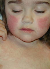 Parvovirus B19
slapped-cheek appearance + rash réticulé
peut précipiter crise aplastique