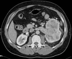 1. This image is a __________ showing a normal ____ KIDNEY but a __________ on the ________ KIDNEY. Diagnosis = _______ ____ _________.
 
2. In this image the _________ is invading the _______ ________ which is quite common for this form of disease.