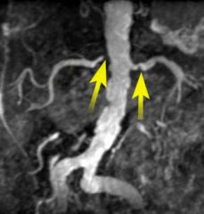 1. In this MRI of the RENAL VESSELS there is _______ RENAL ARTERY ________.


 


2. This is likely to have been caused by SEVERE _________ which can be seen on the _____ also.