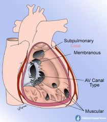 Associations with VSD

Part of Tetralogy of Fallot
50% of patients with a VSD have an associated additional cardiac abnormality
- Coarctation of the aorta
- Aortic stenosis
- Tricuspid atresia