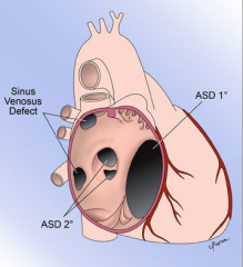 ASD

- thromboemolic stroke
- Downs (prim)
- Anomalous pulmonary venous return
- Holt- oram (sec)
- Lutembacher