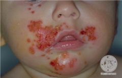 infection superficielle à staph aureus ou strept b-hémolytique
croûte jaunâtre